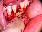 Knochenblock-Implantation Bild 2